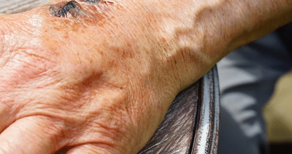 Cicatrización de las heridas